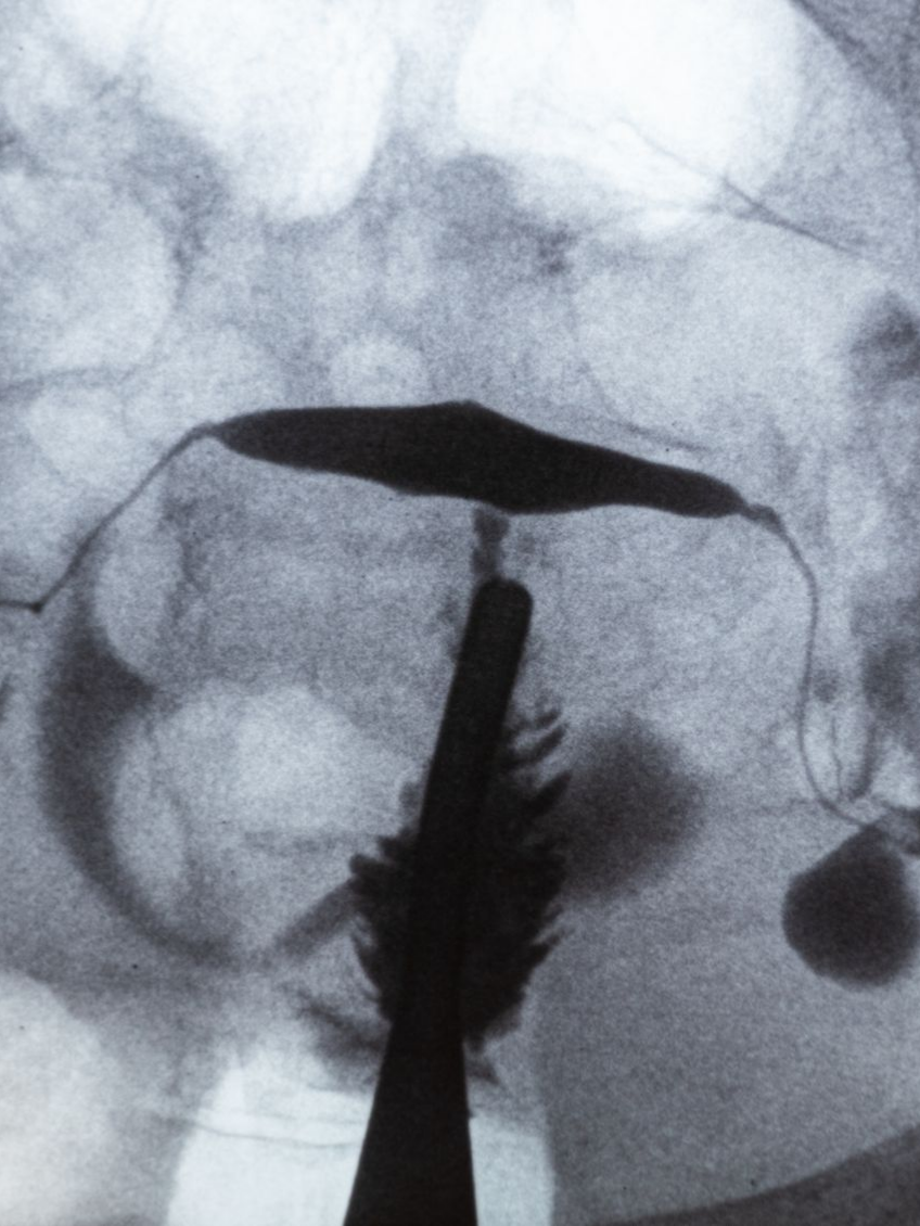 Utérus vu aux rayons X