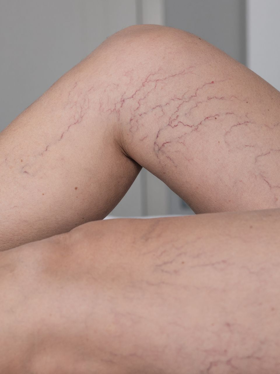 Varices sur des jambes