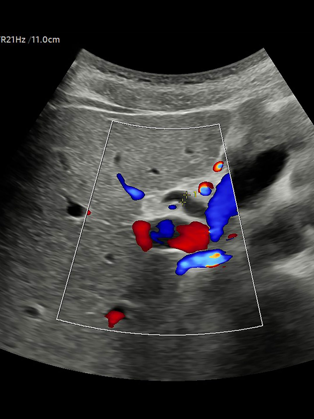 Cliché d'une échographie du pancréas
