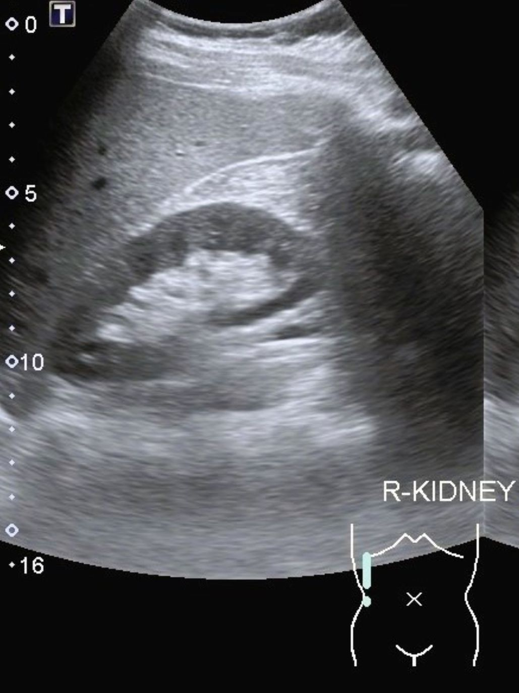 Échographie d'un rein
