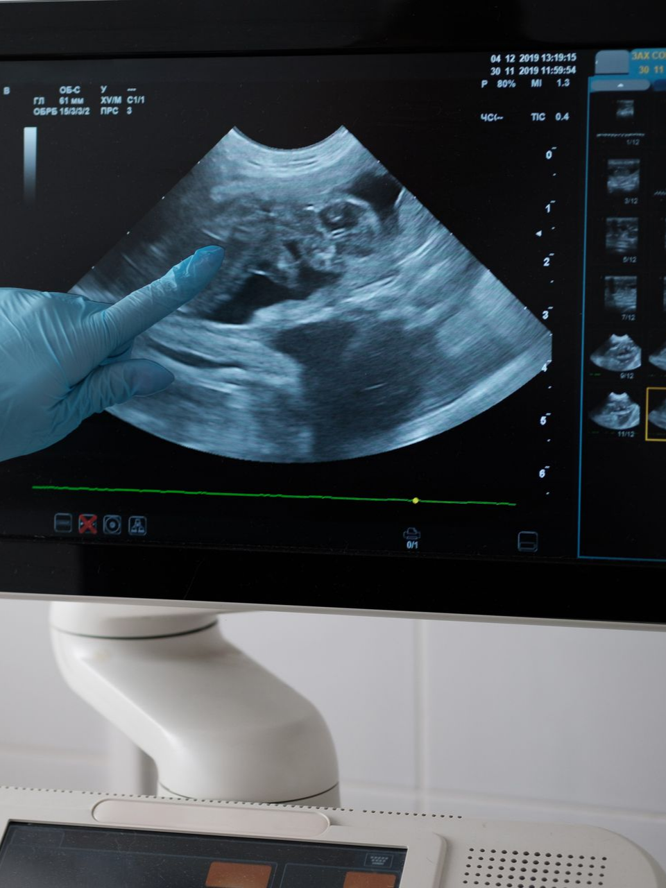 Doigt montrant un fœtus sur une échographie