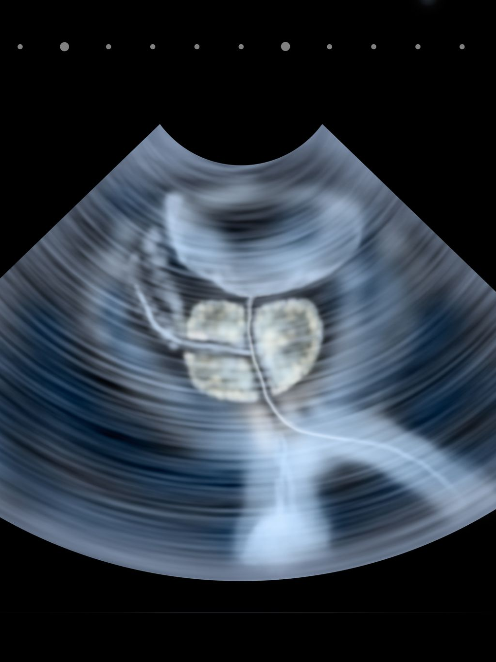 Illustration d'une échographie de la prostate