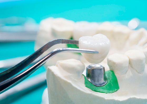 Un primer plano de un modelo de un diente con un implante dental.