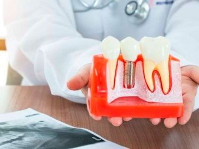 Un médico sostiene en sus manos un modelo de un implante dental.