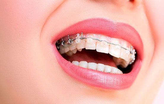 Un primer plano de la boca de una mujer con aparatos dentales.