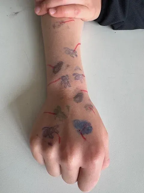 Kinderarm mit verschiedenen dunkel gefärbten, pflanzenähnlichen Stempeln und roten Linien auf der Haut, Faust auf weißer Oberfläche geballt.