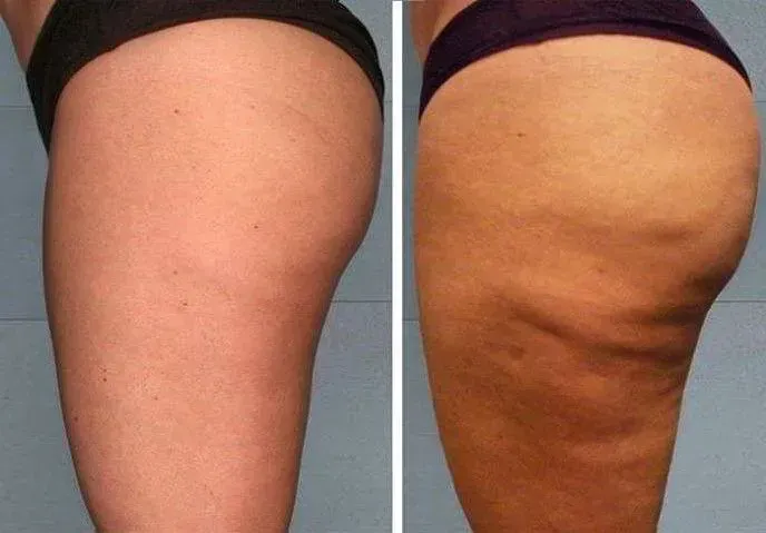 Comparación del antes y el después que muestra una reducción de la celulitis en los muslos