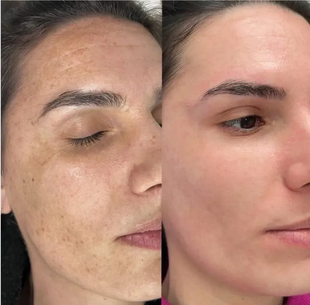 Comparación del antes y el después que muestra una reducción significativa de la hiperpigmentación