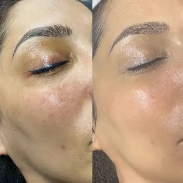 Comparación del antes y el después que muestra una reducción de la decoloración debajo de los ojos