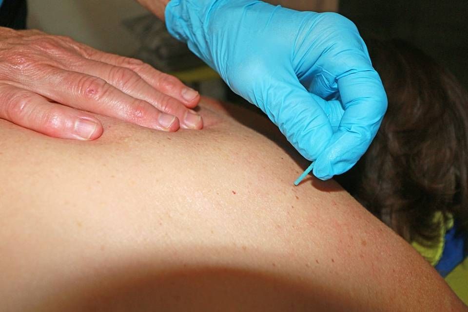 Ein Therapeut mit blauen Handschuhen führt eine Dry-Needling-Behandlung an der Schulter einer Person durch.