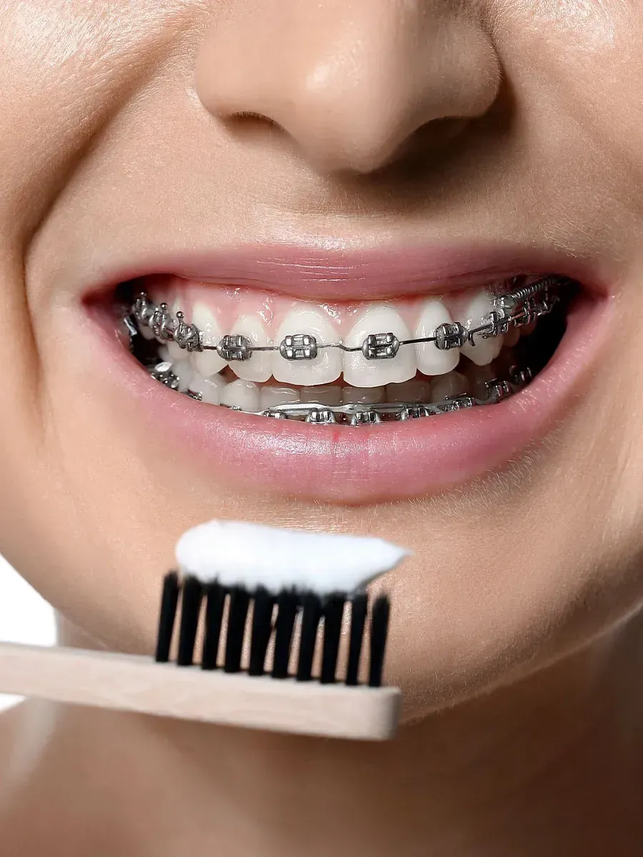 Una mujer con aparatos dentales se cepilla los dientes con un cepillo de dientes.