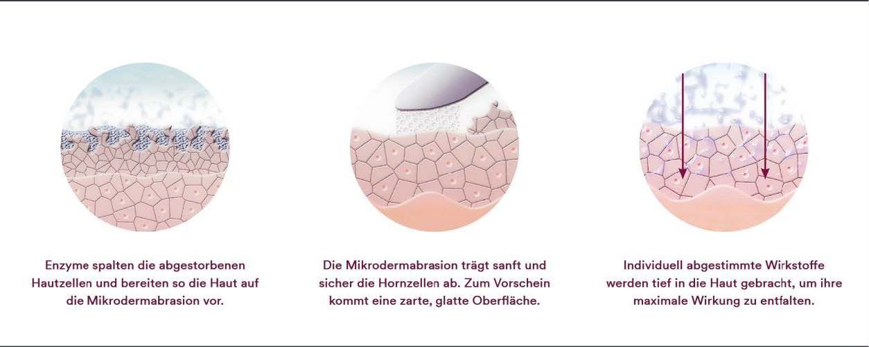 Microdermabrasion Skin Peller Technologie