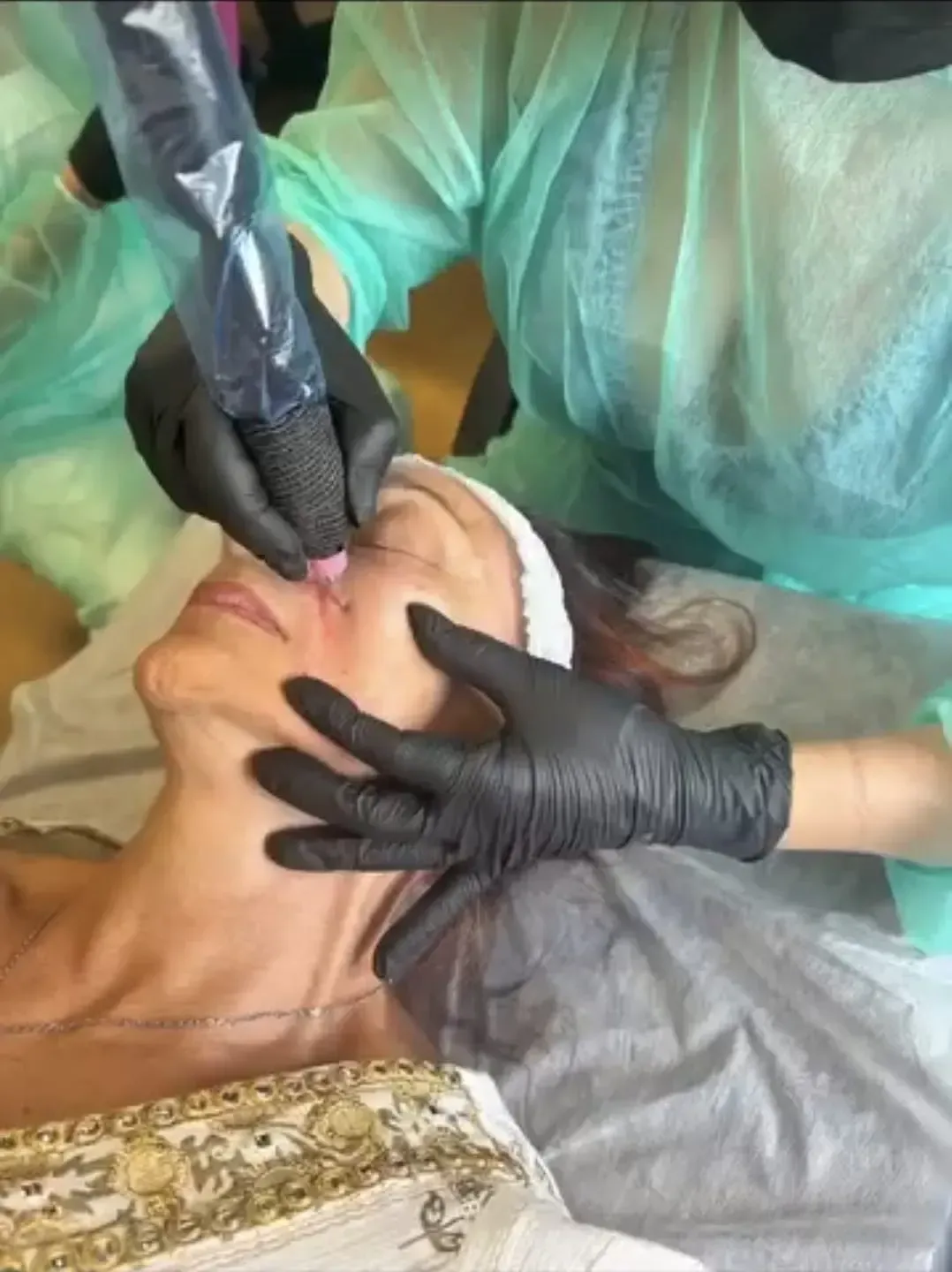 Procedimiento médico en el rostro de un paciente, con manos enguantadas aplicando un tratamiento cerca de la nariz.