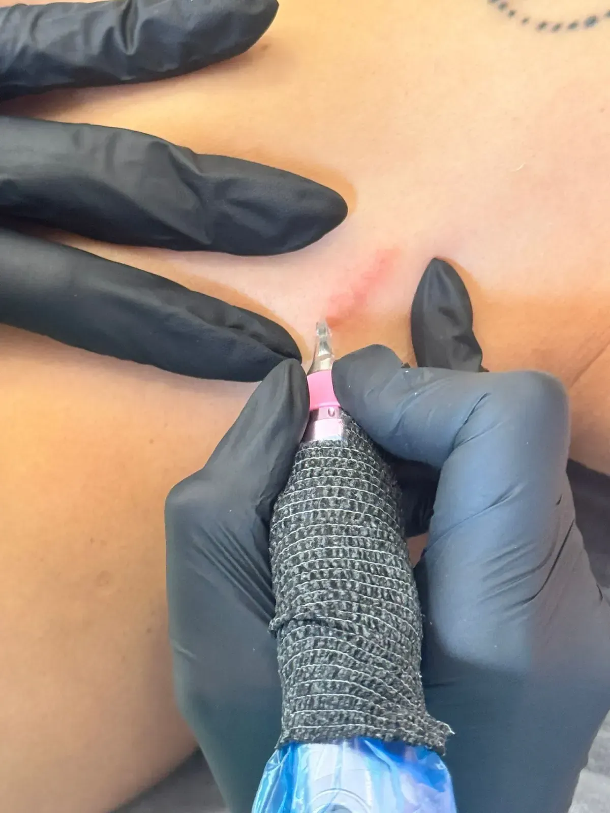 Manos enguantadas inyectando una aguja en la piel (primer plano)
