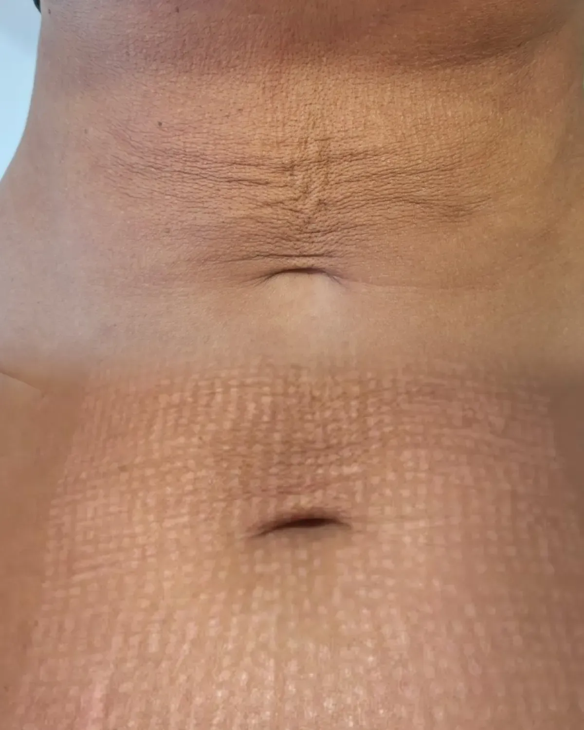 Primer plano de un abdomen con ombligo y textura de piel visible.