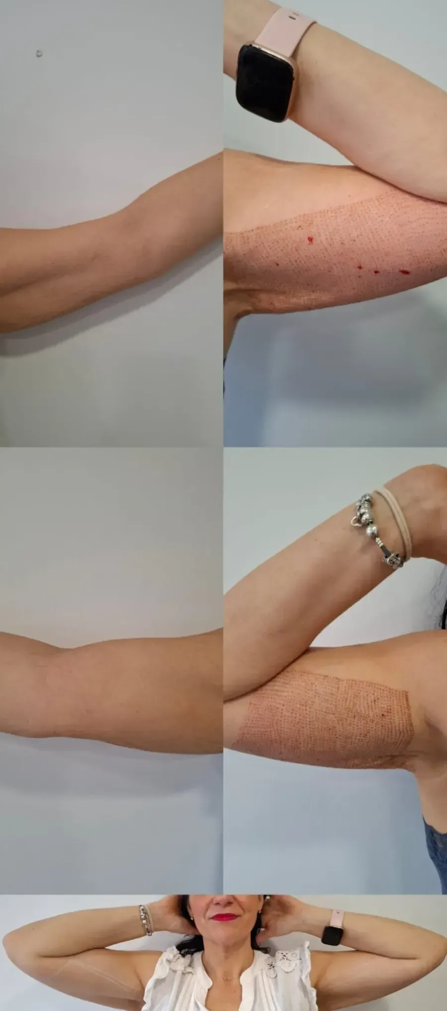 Collage de brazos con decoloración visible de la piel y cicatrices de acné, mostrados en diferentes poses