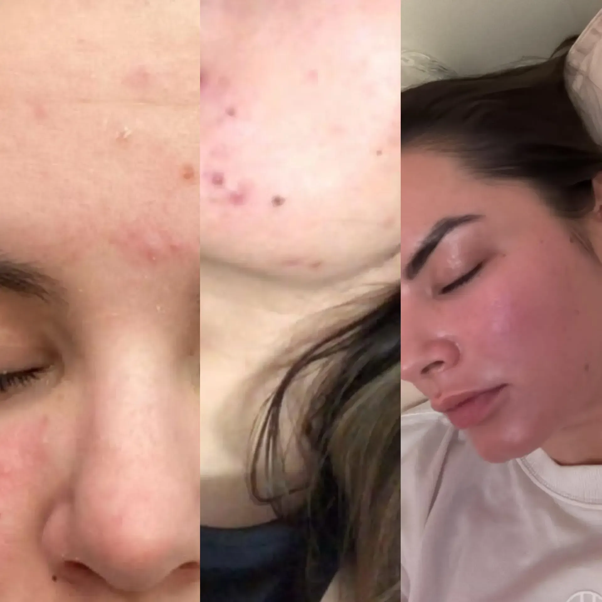 Collage que muestra primeros planos de acné facial y una mujer acostada con el rostro rojo e irritado.