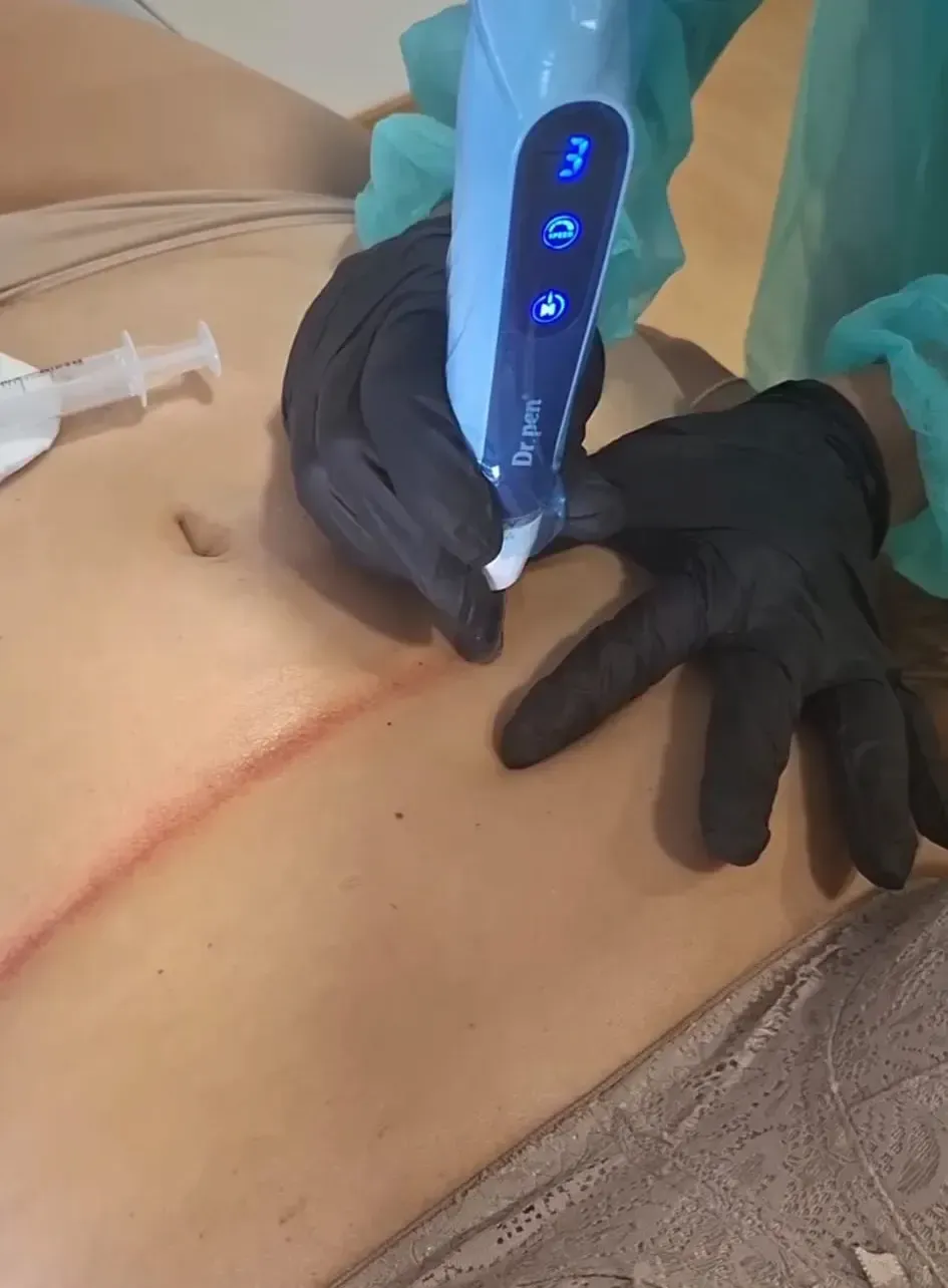 Un médico con guantes utiliza un cauterizador azul en el costado de un paciente, cerca de una pequeña incisión.