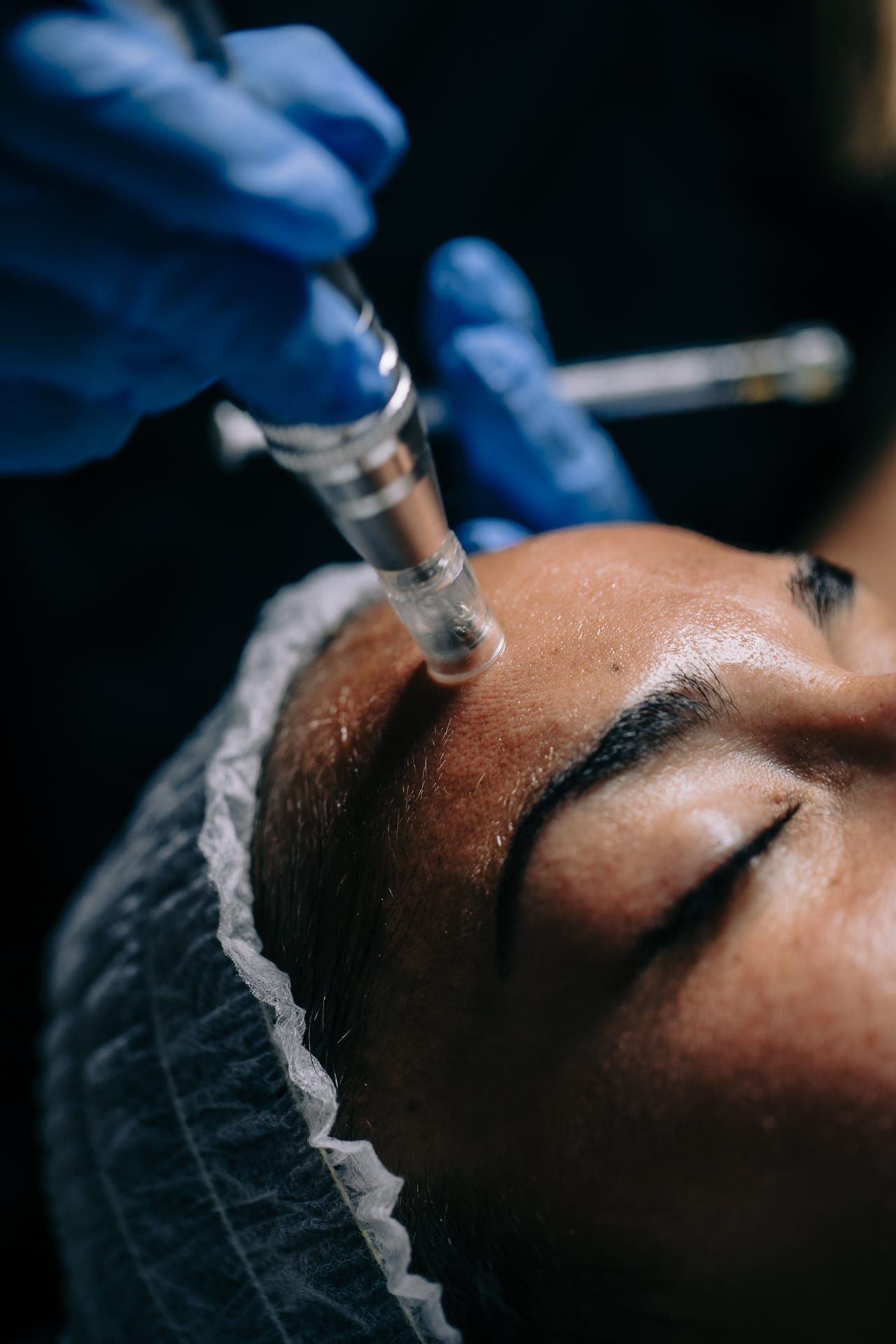 Persona que recibe un tratamiento de microagujas en la frente, realizado con manos enguantadas que sostienen un dispositivo.