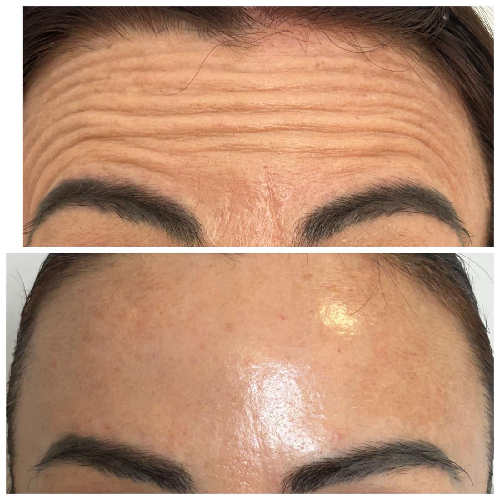 Persona tumbada en una camilla con un traje de baño. La máquina y los espejos se ven al fondo de una sala de tratamiento.