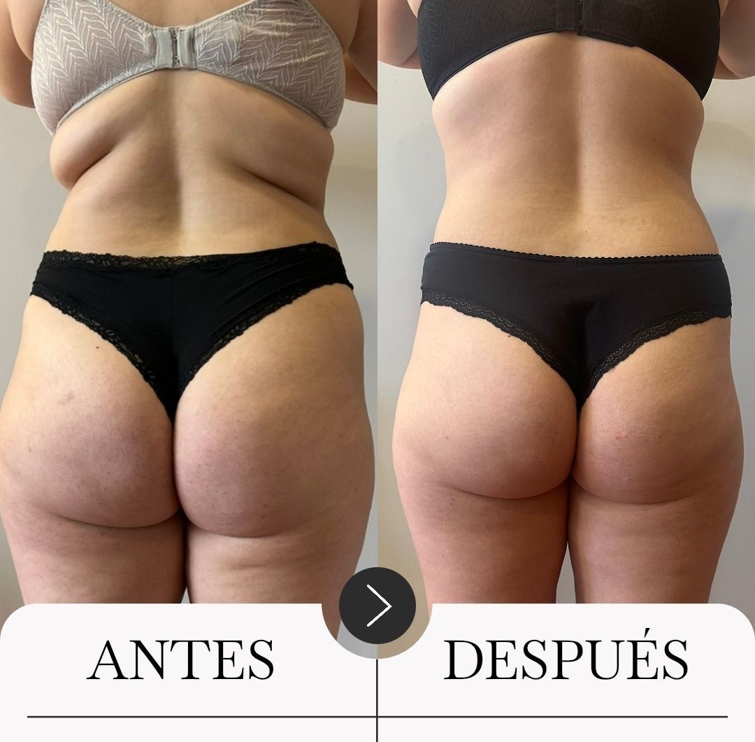 Comparación lado a lado: Glúteos antes y después. La foto del después muestra una reducción de grasa y una piel más tersa.