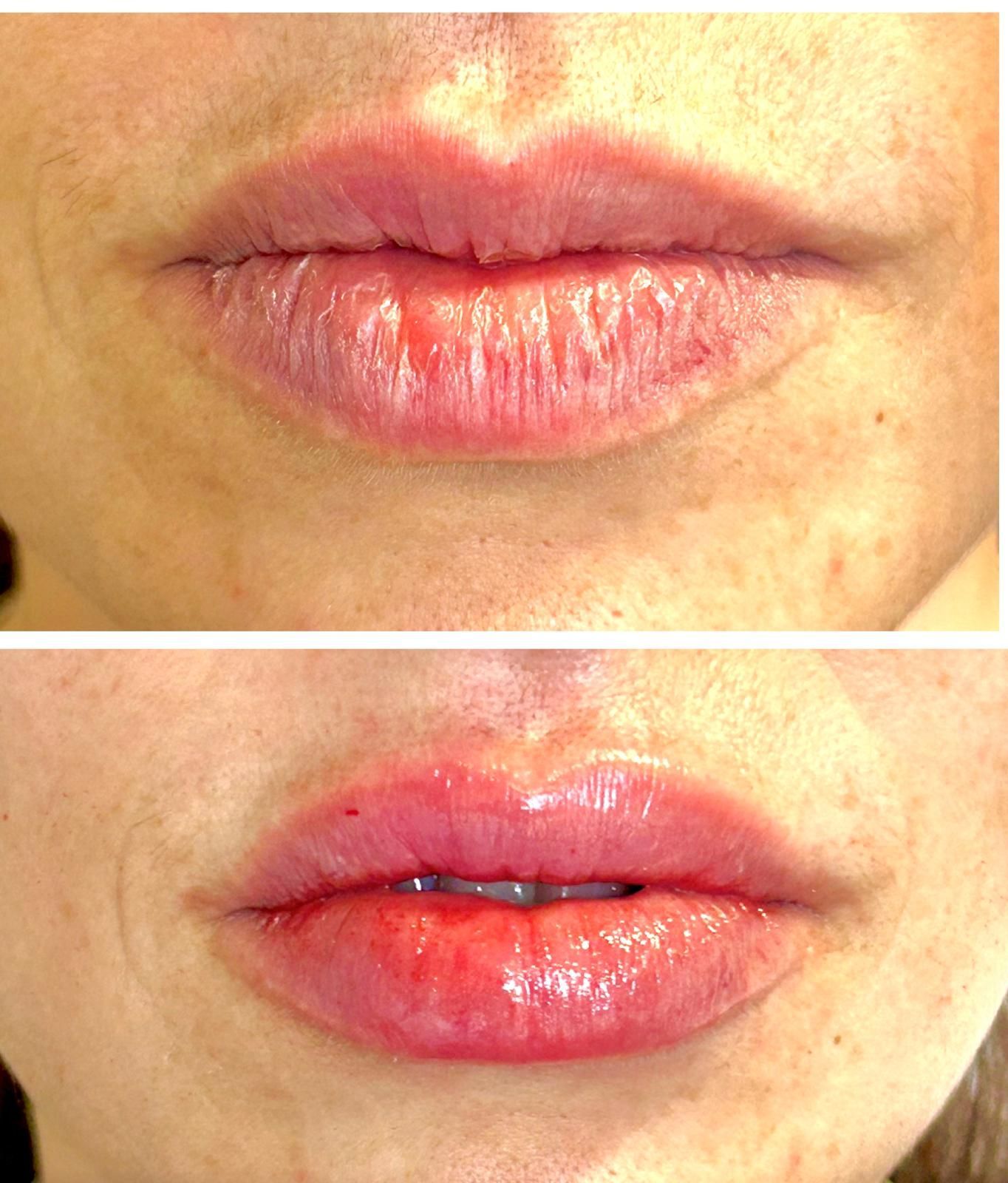 Persona tumbada en una camilla con un traje de baño. La máquina y los espejos se ven al fondo de una sala de tratamiento.