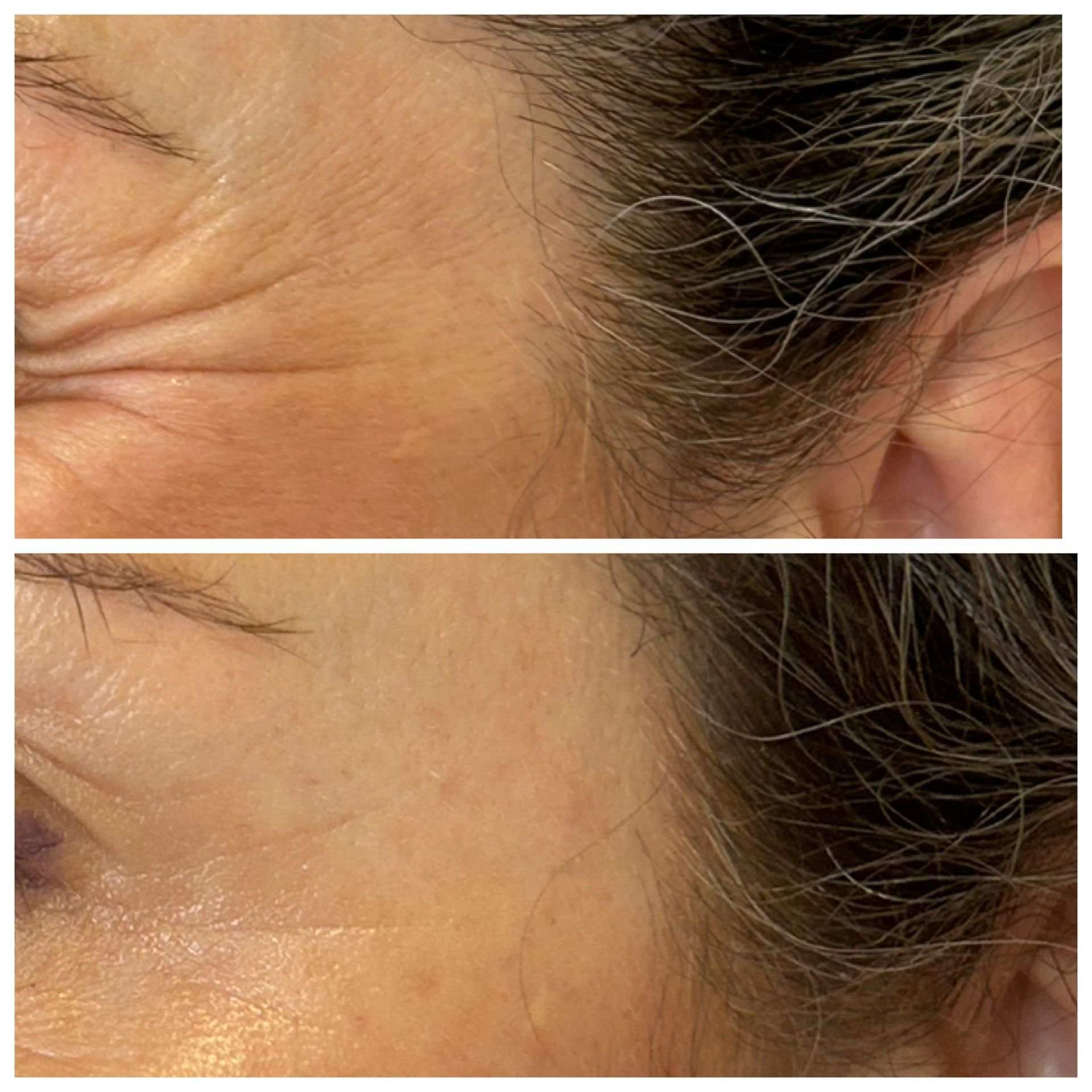 Antes y después de la piel del rostro: reducción de arrugas alrededor de los ojos tras un procedimiento cosmético.