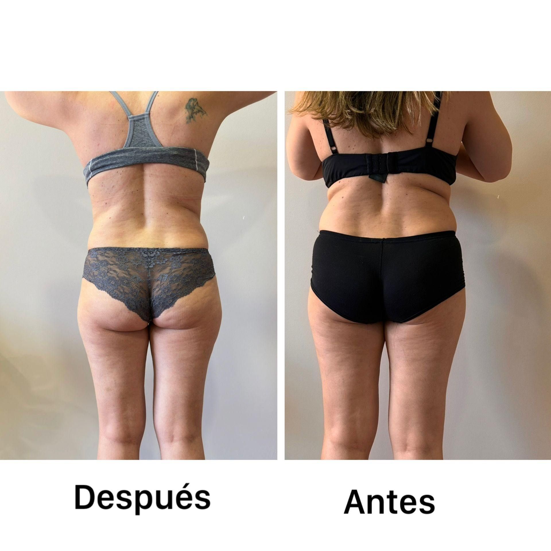 Antes y después de la zona lumbar y las piernas de una persona.