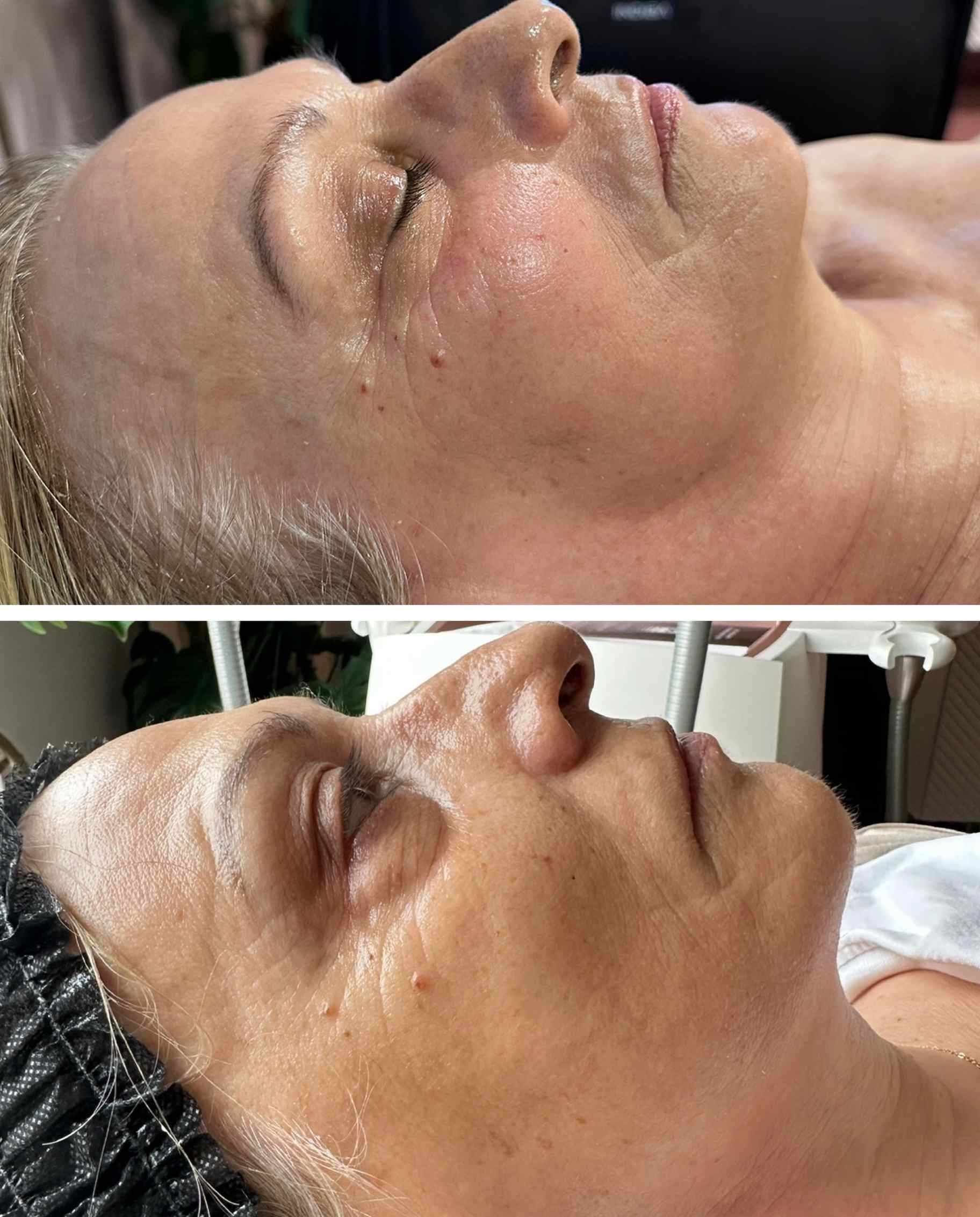 Dos vistas de perfil del rostro de una persona, posiblemente durante un tratamiento facial.