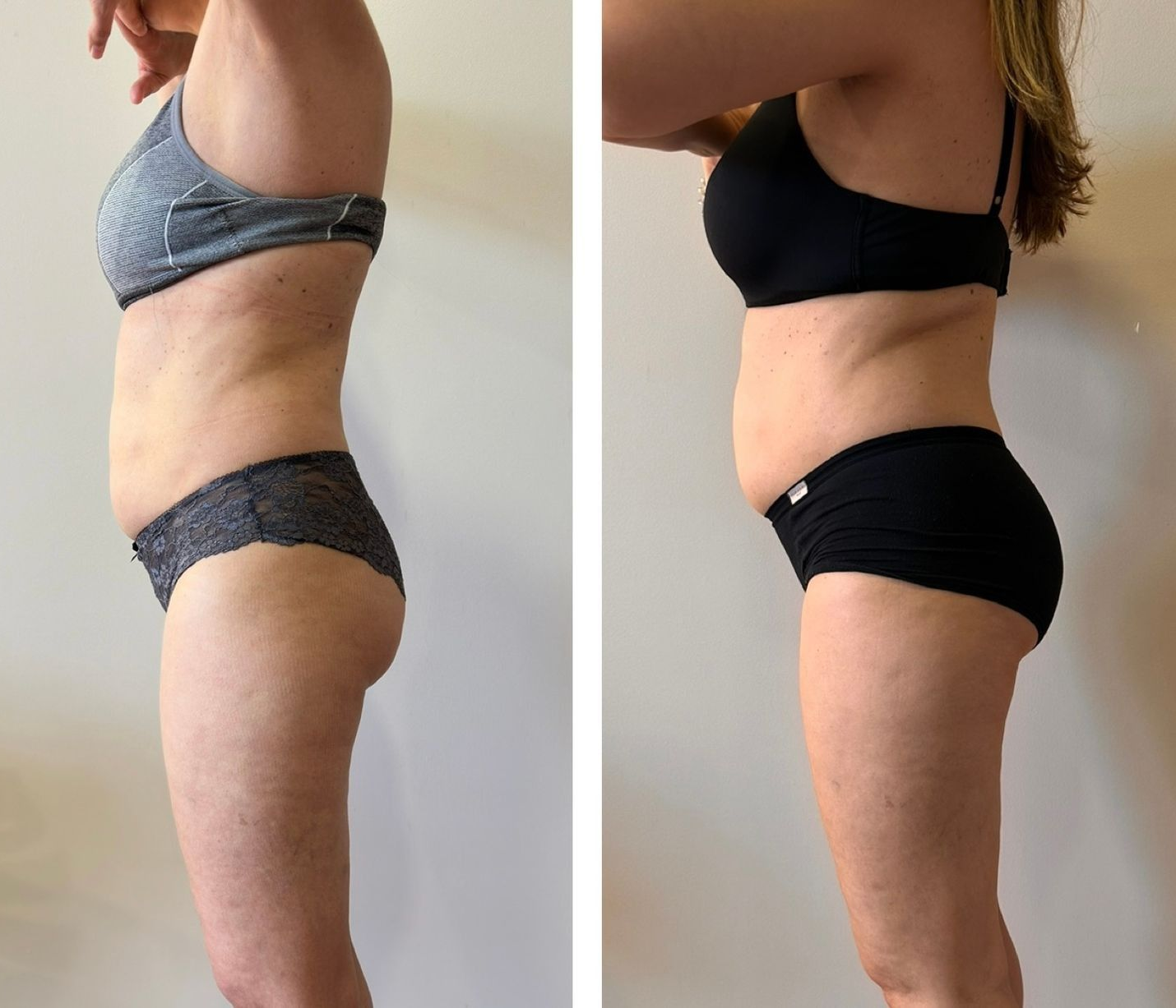 Fotografías comparativas del torso de una persona en ropa interior. 