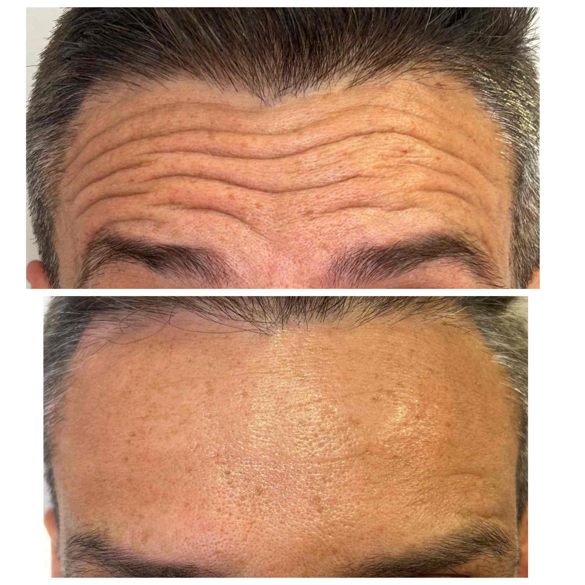 Arrugas en la frente antes y después del tratamiento, mostrando una reducción en las líneas.