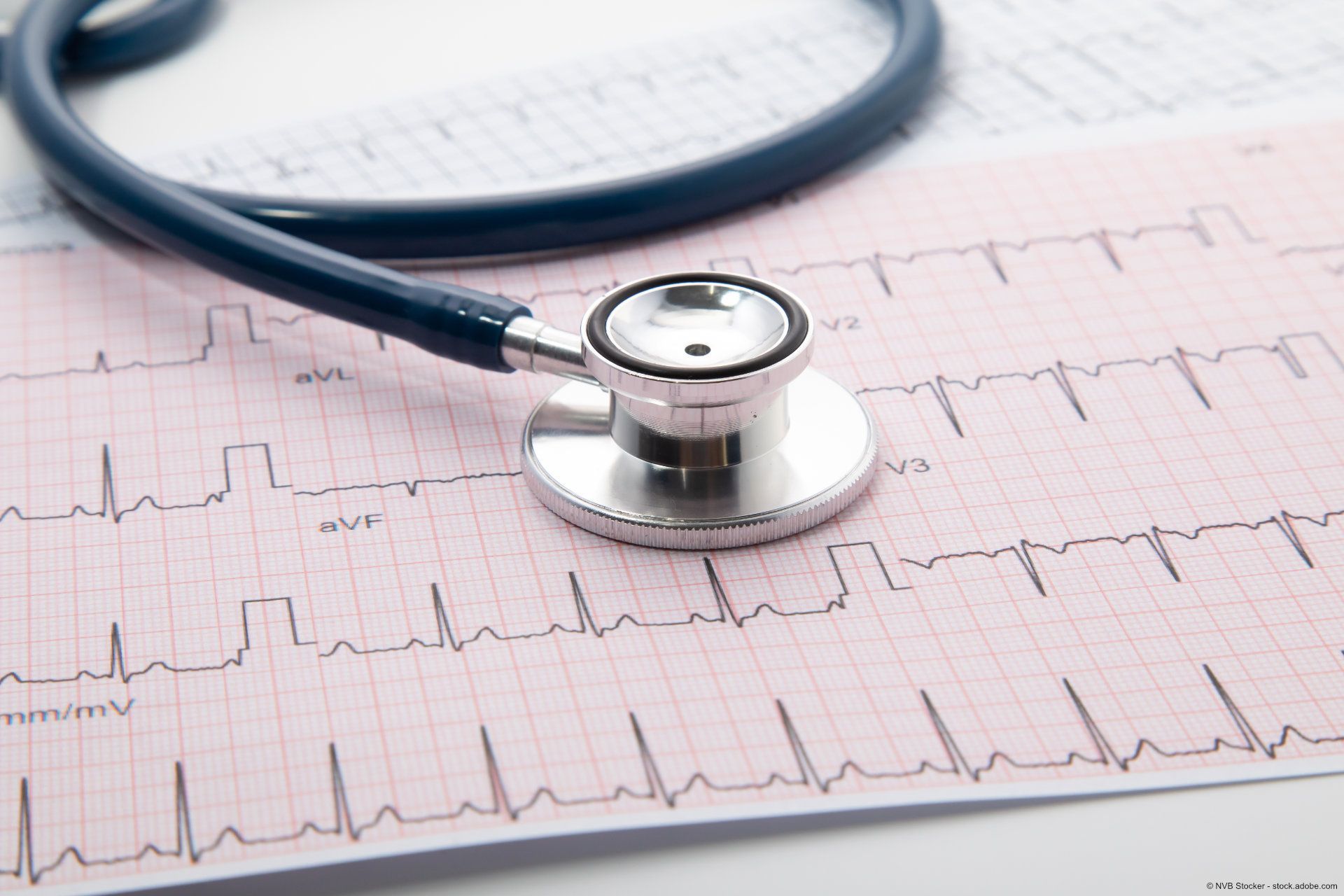 Ergebnisse eines EKGs