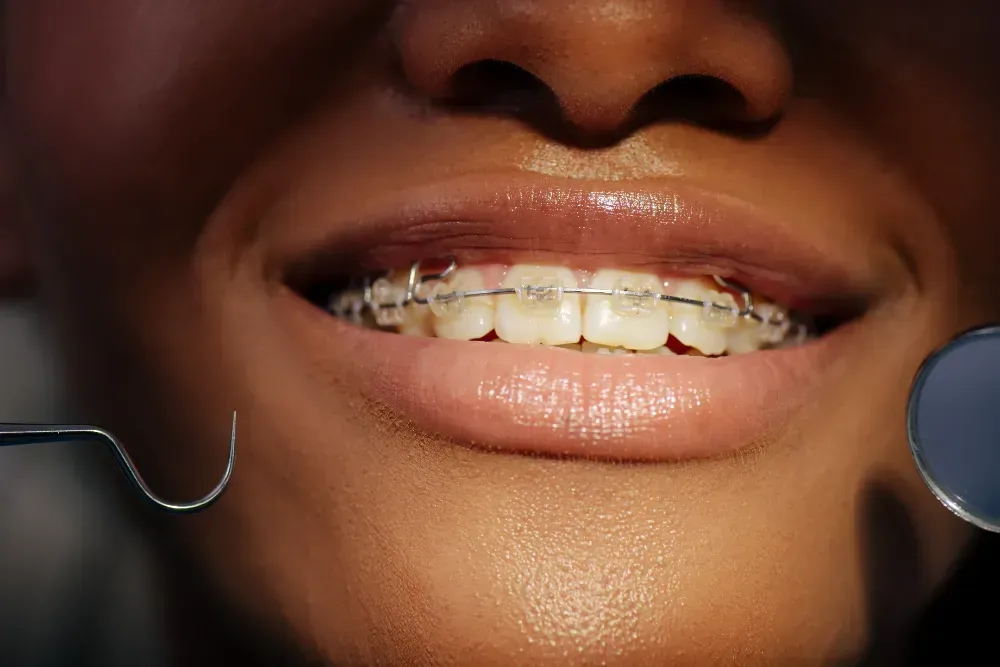 Orthodontics: Transform Your Smile
