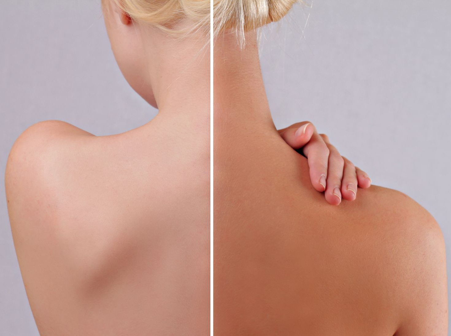 Dos de femme avant et après une séance de bronzage. Peau claire à gauche, peau bronzée à droite.