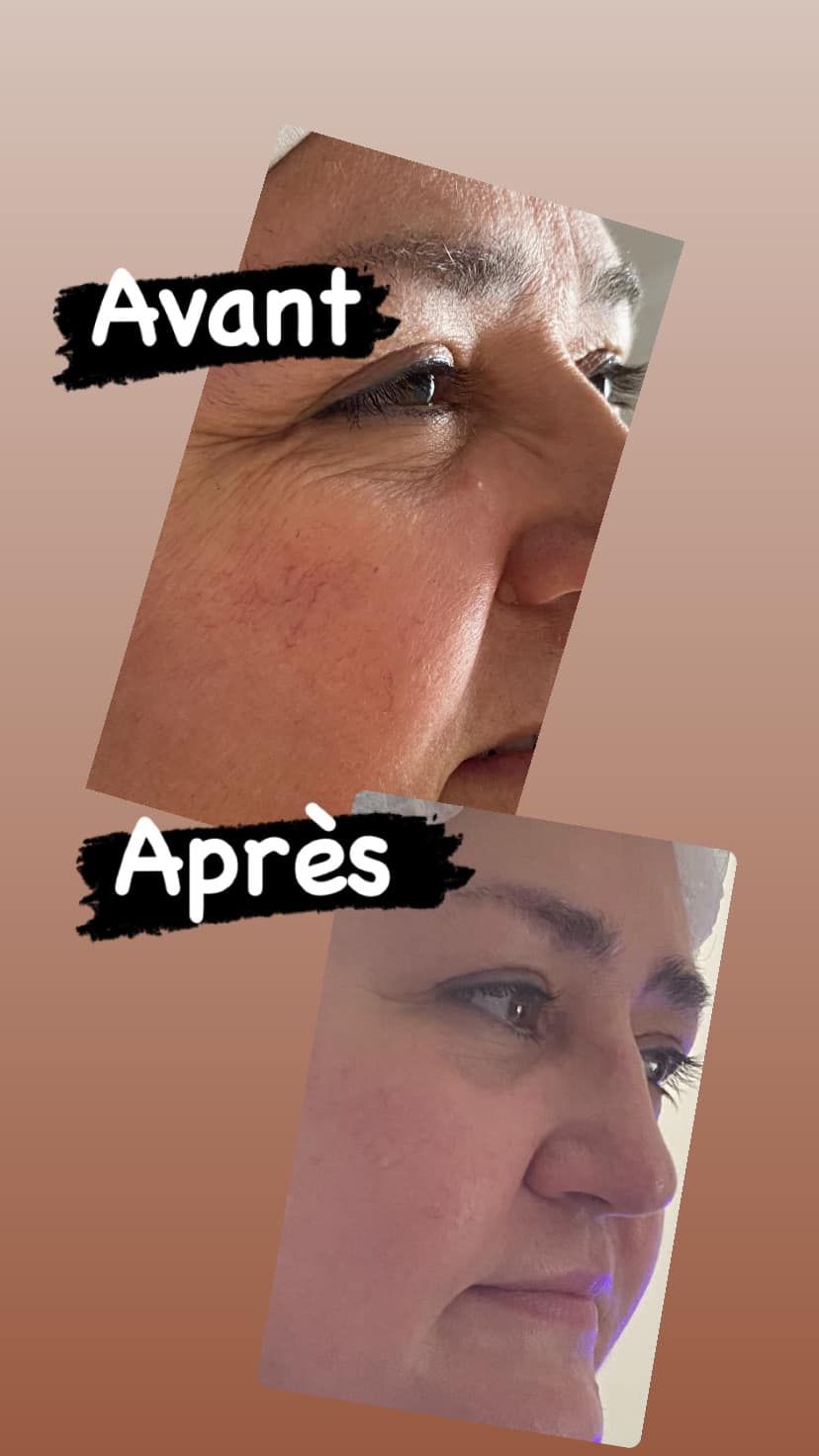 Soin HydroFacial sur le visage d'une femme, avec mentions Avant et Après.