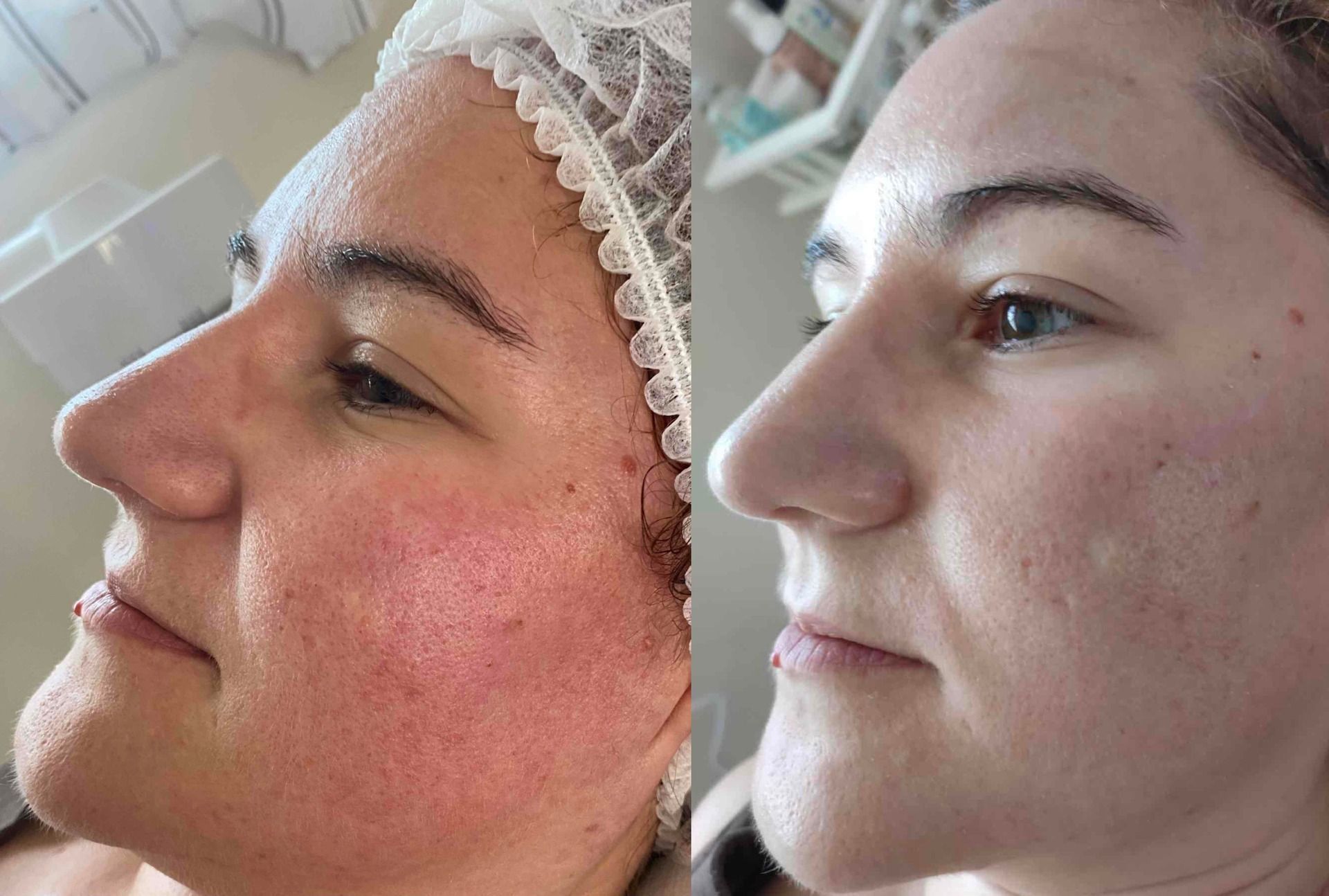 Avant après : visage de femme avec rougeurs avant le soin et teint lumineux après le soin.