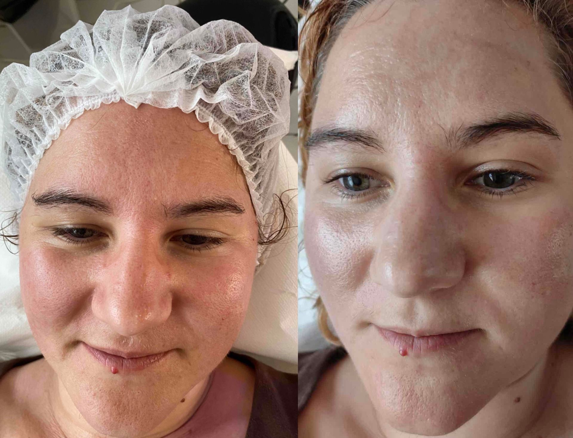Visage de femme avec rougeurs avant le soin et teint lumineux après le soin.