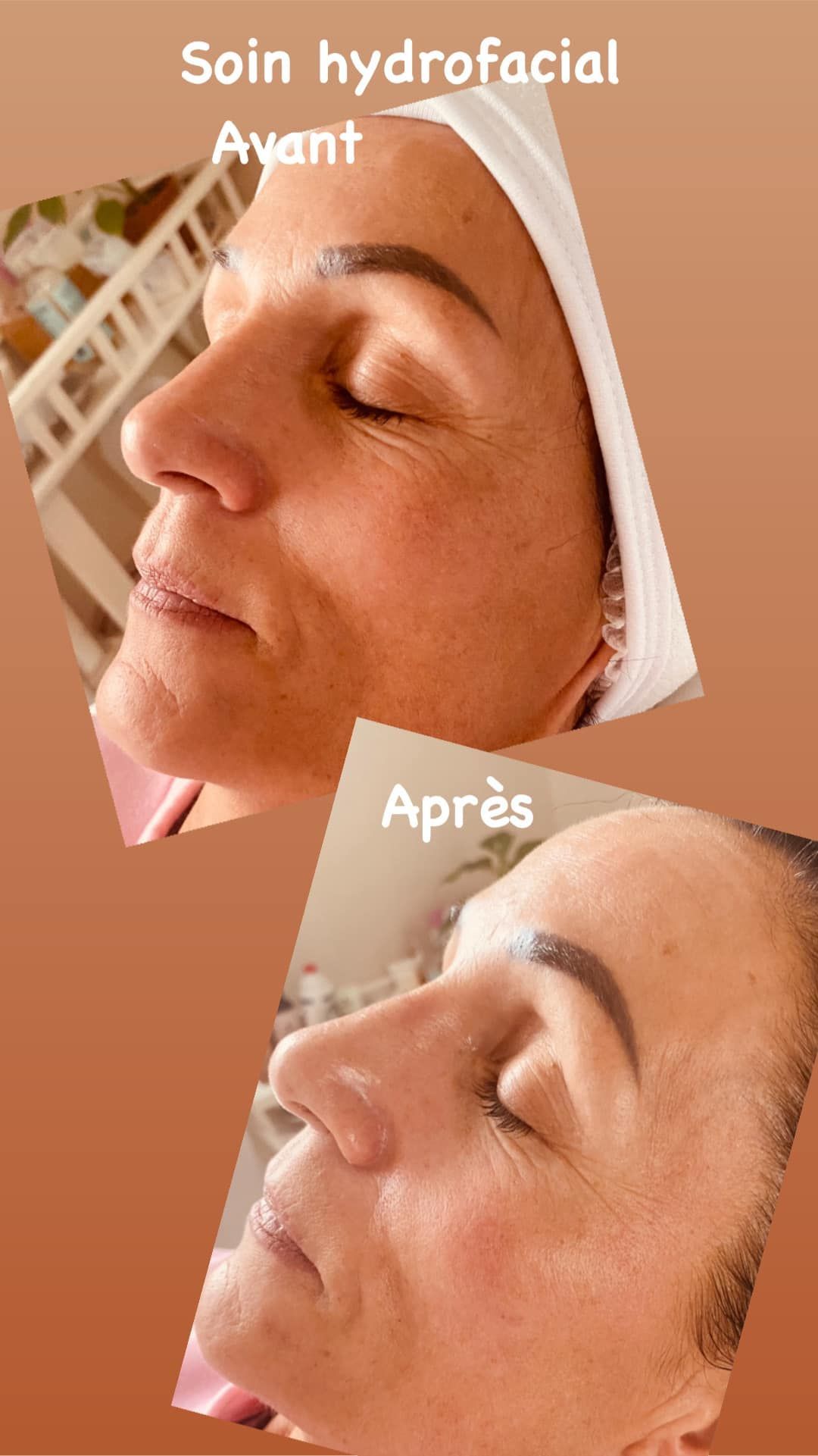 Traitement HydroFacial sur le visage d'une femme, avec mentions Avant et  Après.