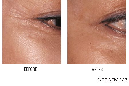 Trattamento anti-età contorno occhi - M. W. Medicina Estetica