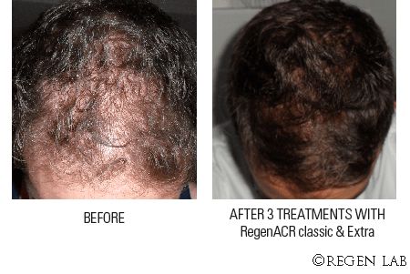 Trattamento anti-età contro alopecia - M. W. Medicina Estetica