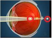 oeil astigmate.JPG