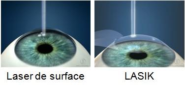 laser lasik.jpg
