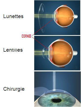 chirurgie laser AVEC CORNEE.JPG