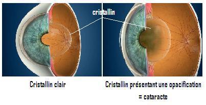 cataracte fleche.JPG