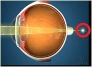 oeil hypermétrope.JPG