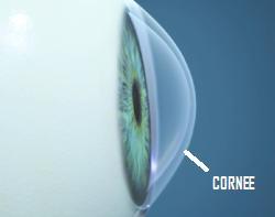 KERATOCONE.JPG