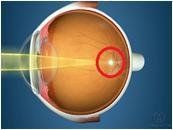oeil myope.JPG
