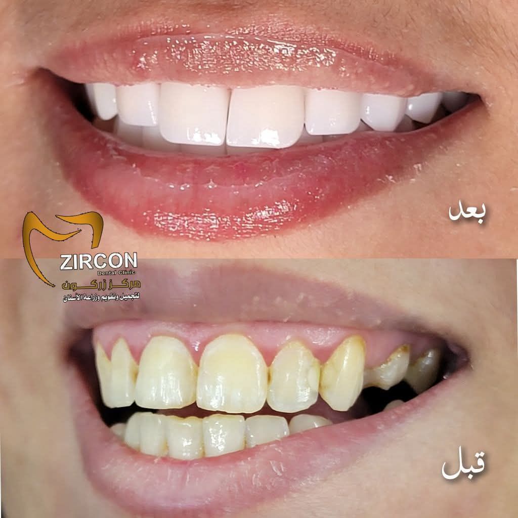 حالة قبل و بعد تركيب عدسات الفينير