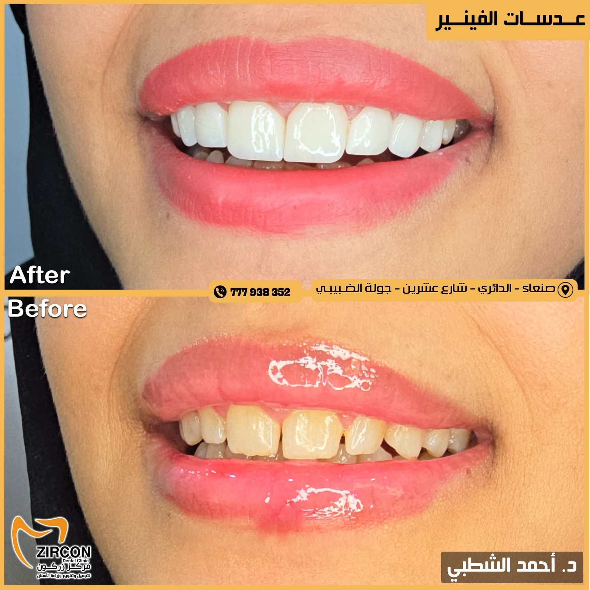 Dental Veneers Comparison
