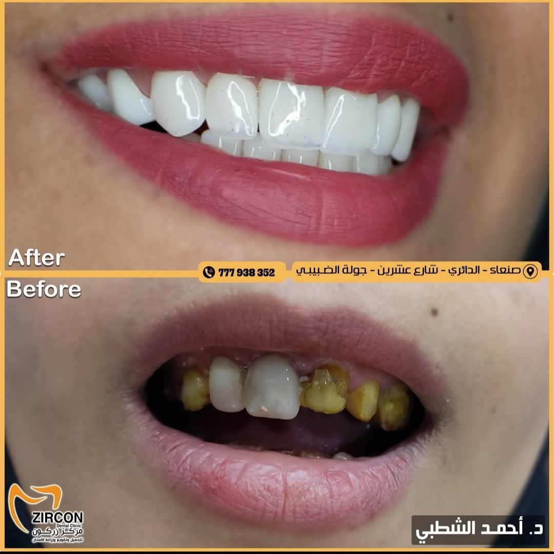 Clear Aligners Technology